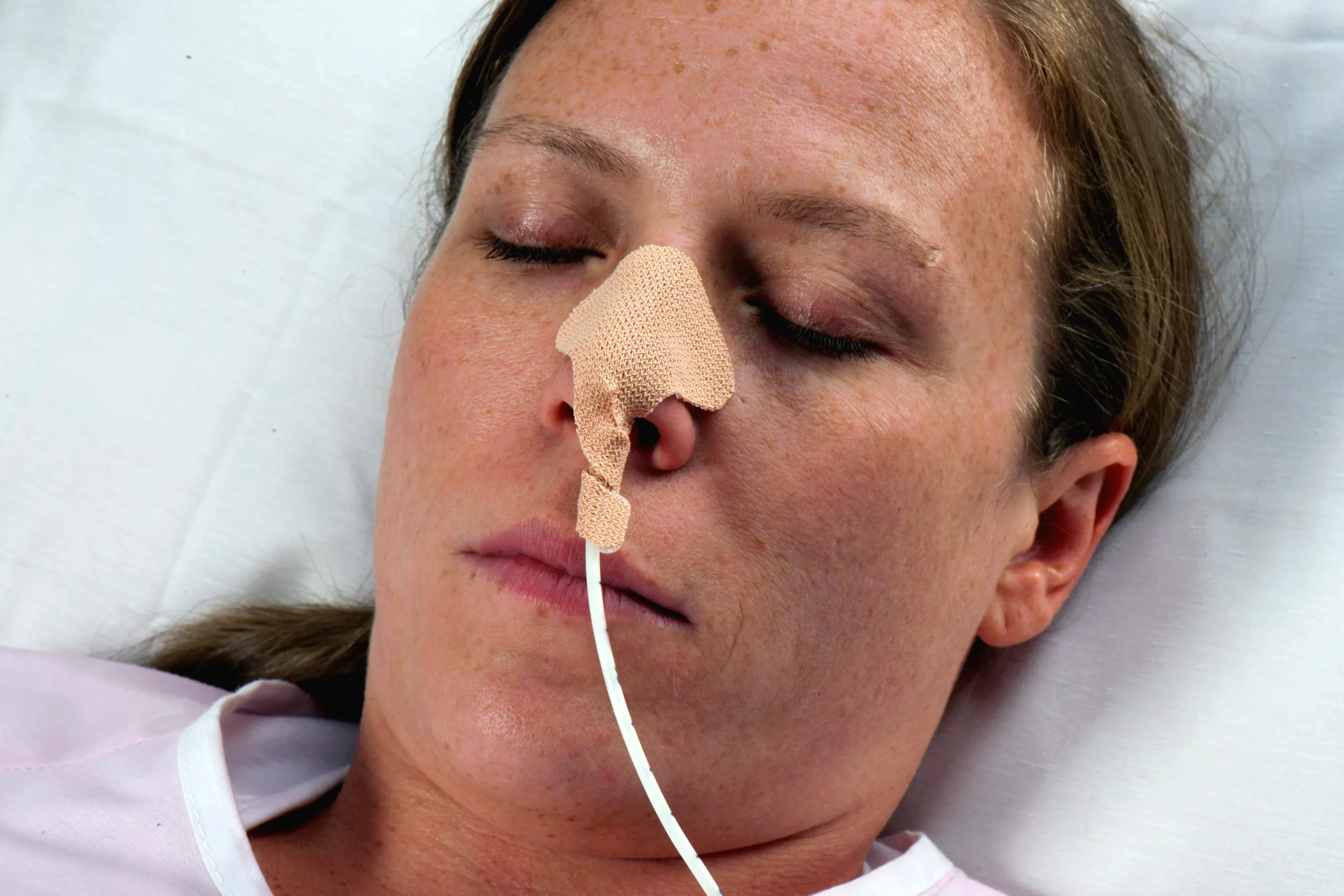 Dale Nasogastric Tube Holder for Nasogastric Feeding and Aspiration Tubes