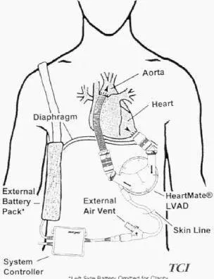 LVAD Management System, Chronic