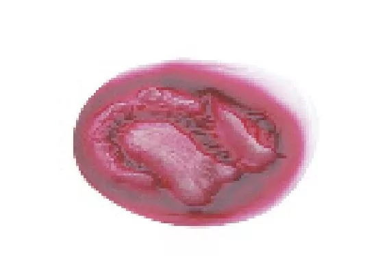 Simulaids Avulsion Major Compound Educational Ea